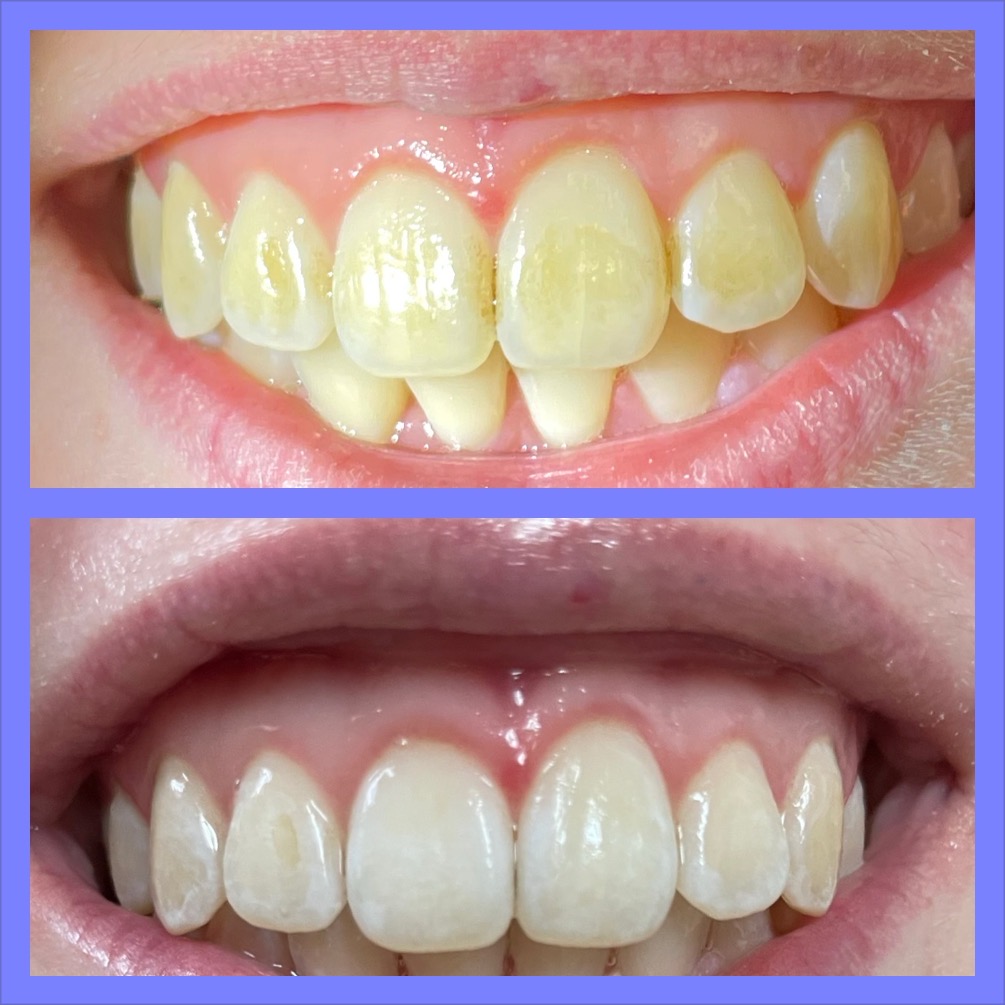 Before and After Teeth Whitening Image